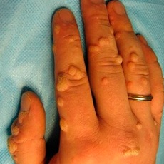 Об эффективном лечении папиллом